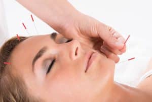 Nirvelli Day Spa acupuncture facial