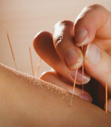 acupuncture cary